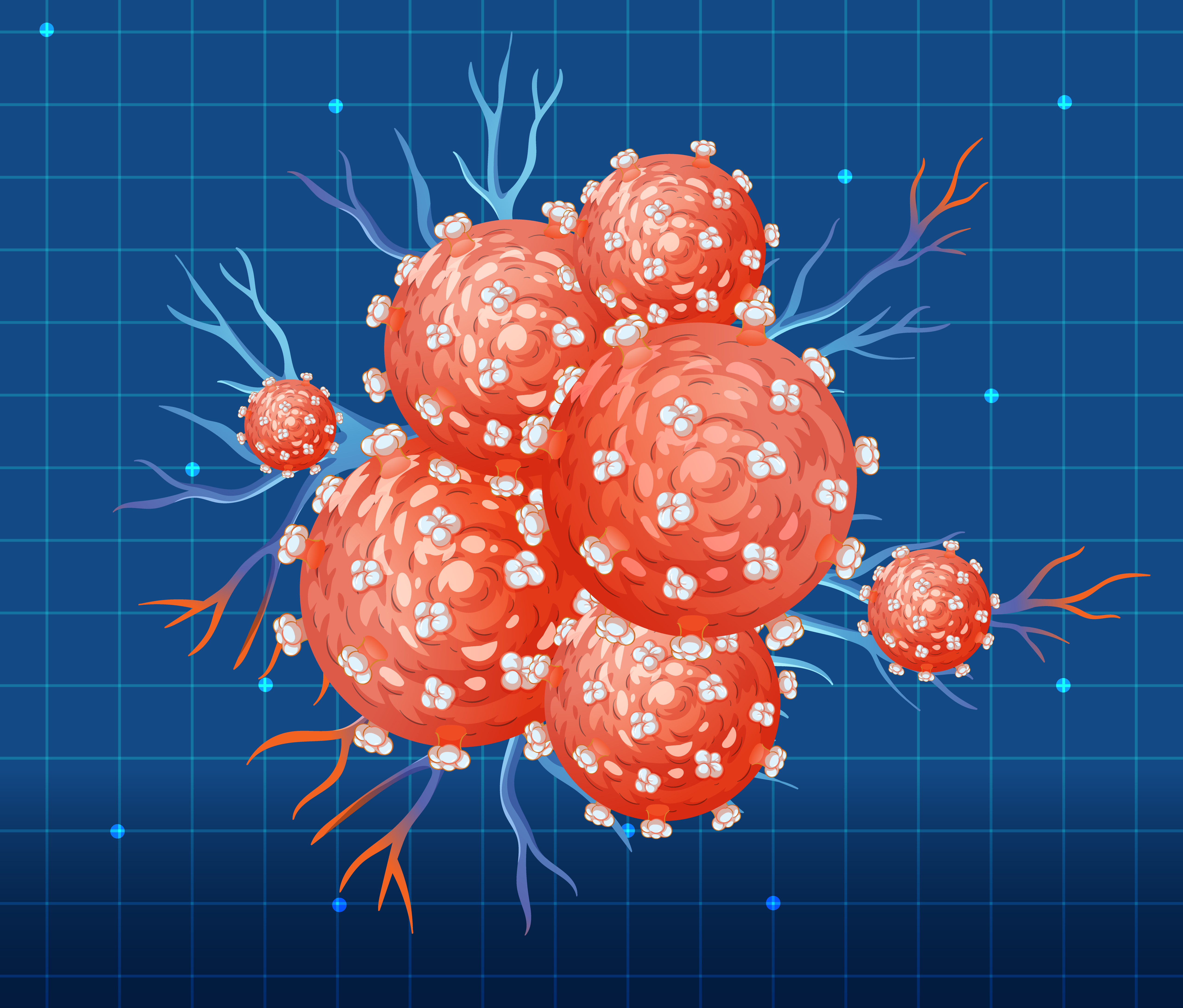 Stadiile cancerului rectal: ce inseamna stadiul I, II, III si IV